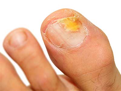 Leczenie grzybicy paznokci stóp